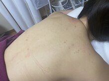 スキンケアスタジオ アコ 新宿店(Aco)/グリーンピールボディ１Day2回