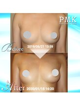 PMK 新宿店/バスト10回施術