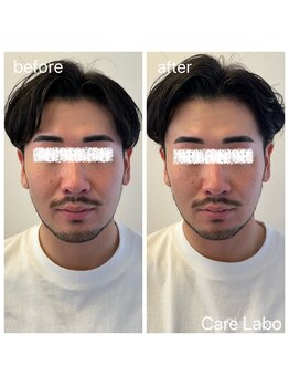 ケアラボ(Care Labo)/【FN美容鍼】