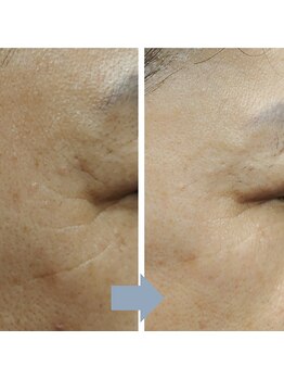 レベンディス(LEVENDIS)/ララピール×美容液導入