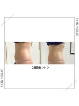 スキンホリック 恵比寿駅前店(SKIN HOLIC)/お腹☆ビフォア＆アフター★