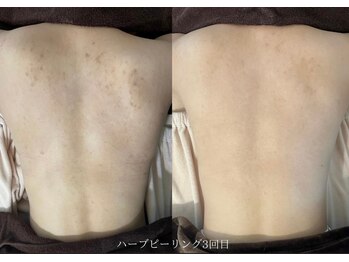 エヌハーブ(NHerb)/背中ハーブピーリング3回