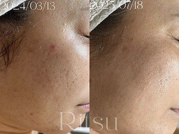 リツ(Ritsu)/毛穴