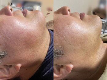 ピュアリー(purly)/【レモンボトル】Before After