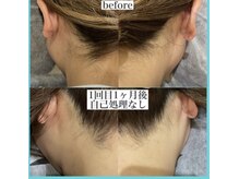 アクト クロ(ACT curro)/【うなじ襟足】脱毛施術例