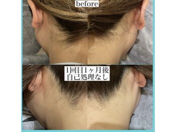 アクト クロ(ACT curro)/【うなじ襟足】脱毛施術例