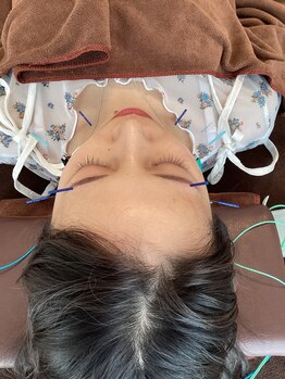 ハリファ鍼灸院 横浜関内院(HariFa鍼灸院)/美容施術