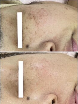 ナルフロウ(nalufurou)/独自配合の国産ハーブピーリング