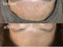 ビビ(Vivi)/額ニキビケア