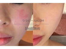 ライフサロン 恵比寿(Life Salon)/水分量UP！みずみずしい肌に♪