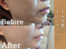 くすみ・ごわつきが改善され、美白水光肌へ◇