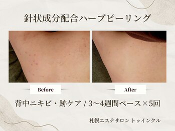 プライベートエステサロン トゥインクル/隠したくなる背中から卒業♪