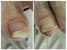 フレッシュフット(FreshFoot)/足のトラブルお任せください