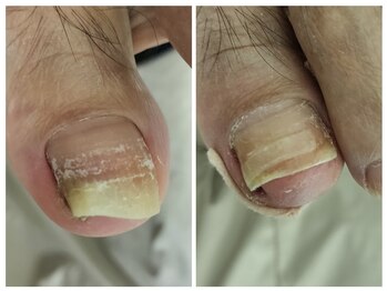 フレッシュフット(FreshFoot)/足のトラブルお任せください