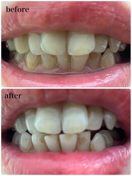 ベベクロスディディア 野々市市役所前店(Bebe×DiDiA)/セルフホワイトニング