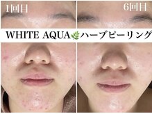 ホワイトアクア 浜松店(WHITE AQUA)/ハーブピーリング/ニキビケア