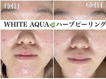 ホワイトアクア 浜松店(WHITE AQUA)/ハーブピーリング/ニキビケア