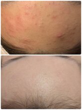 サロン エム(Salon M)/プラズマエクソソーム導入