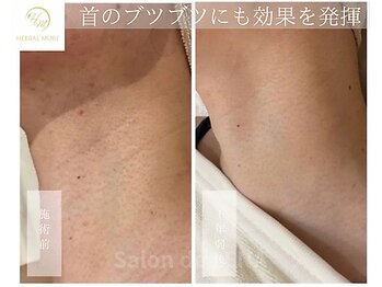 サロンドレナ 名駅店/ハーブピーリング サロンドレナ