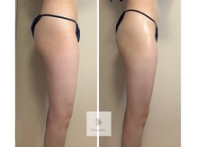 パピヨン(Papillon)/一度減った脂肪は戻らない