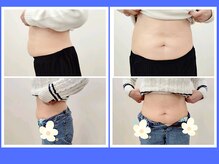 縁(en)の雰囲気（脂肪冷却で激減の脂肪♪）