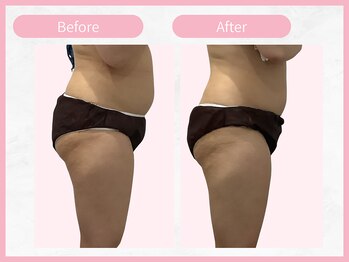 RHB 横浜店/【痩身コース】ビフォーアフター