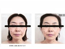 エクレボーテ(ECOULERBEAUTE)/施術例：ハーブピーリング