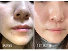 AK エステティックス(AK Esthetics)/敏感肌/初めての方はこちら★