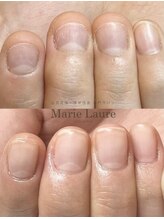 マリーロール 天王寺店(Marie Laure)/自爪育成/深爪矯正/ネイルケア