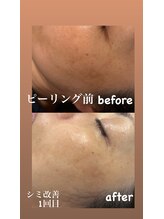 ヒーリングサロン イチマルイチ(101)/ホワイトスノーピーリング 効果