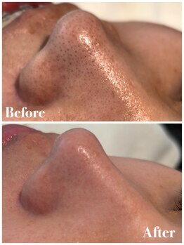 ピュア 川越店/毛穴プレミアムコース