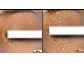 マロン(MARON)/艶肌/ラミネーションピール