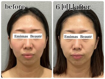 エミマス ボーテ(Emimas Beaute’)/６回でキュッとすっきり小顔へ！