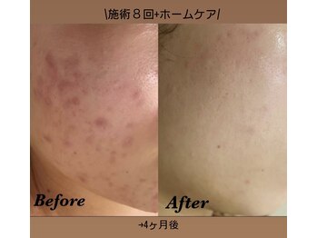 メナードフェイシャルサロン 片町店/早期で綺麗になりたい人必見!