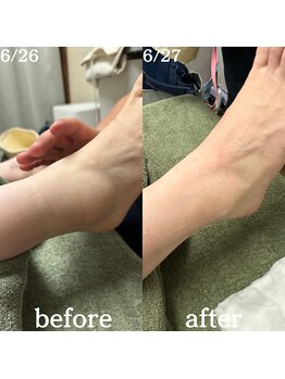 恵比寿ループ鍼灸院(LOOP)/捻挫before&after