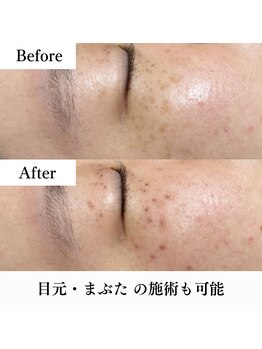 ブレリアントサロン 池袋店(brillant salon)/【施術】シミケア_施術後