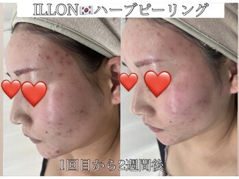 ラ ミュエル(La miel)/ILLONハーブピーリング1回目