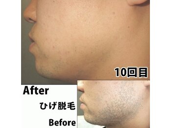 ビビット(BIBITTO)/ヒゲ脱毛ビフォーアフター