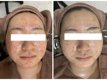 ホワイトアクア 岐阜店(WHITE AQUA)/ハーブピーリング/岐阜/ニキビ