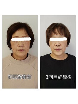 シェルスラン/小顔矯正