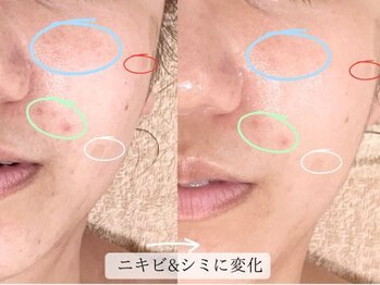 こもれび/１回のお手入れでの変化