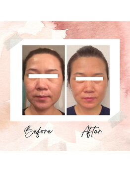 プレジール(Plaisir)/サーマトリックス★3回