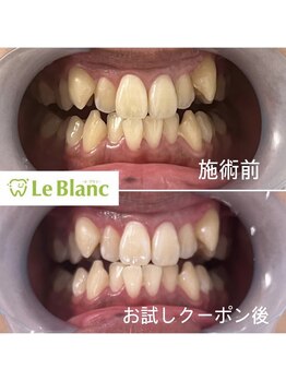 ルブラン 奈良店(Le Blanc)/歯のくすみまで!