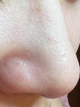 ジェリー(JERRY)の写真/《貸切サロン》1つ1つの角栓を丁寧に除去し、詰まり/黒ずみ/ザラつきをリセット！毛穴をキュッと引き締め◎