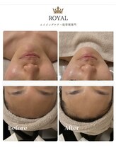 ロイヤル(ROYAL)/スキンメイド×小顔リフト