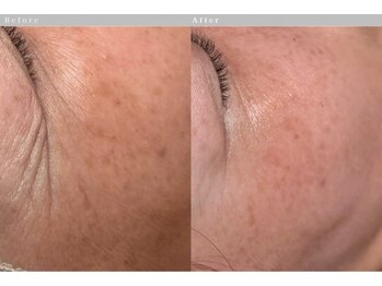 ルーツリー(Rootree)/肌管理フェイシャル