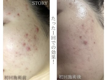 ストーリー 岐阜店(STORY)/ハーブピーリング専門店STORY