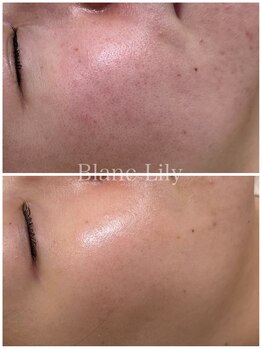 ブランリリー(Blanc Lily)の写真/【薬院の人気サロン】乾燥・赤み・ニキビなど、春特有の“ゆらぎ肌”にお悩みの方に☆