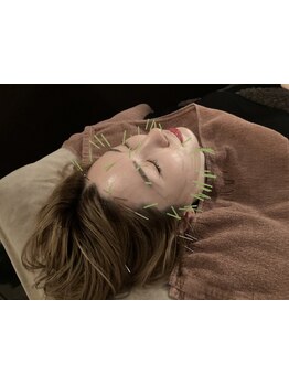 鍼灸施術を受けたい