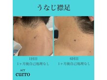 アクト クロ(ACT curro)/【うなじ襟足】脱毛施術例